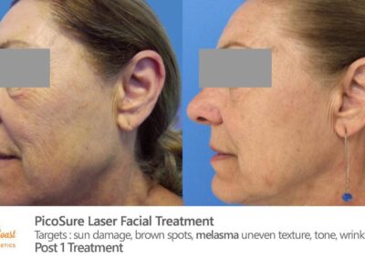 PicoSure Laser Before and After Photos Irvine CA