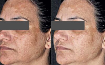 Melasma, Hyperpigmentation, Brown Spots. What is the difference? What is the best treatment?