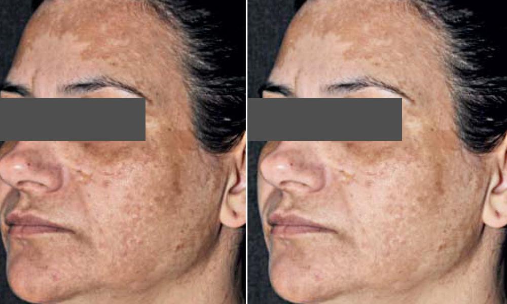 Melasma, Hyperpigmentation, Brown Spots. What is the difference? What is the best treatment?