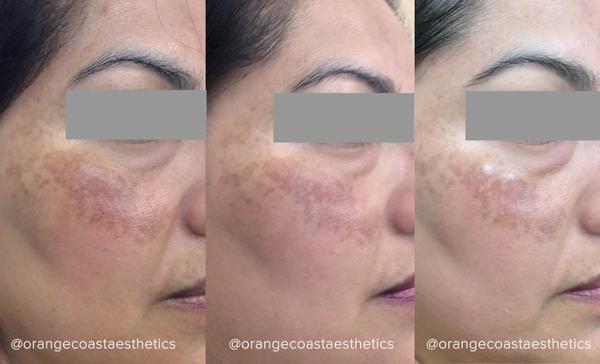 Melasma, Hyperpigmentation