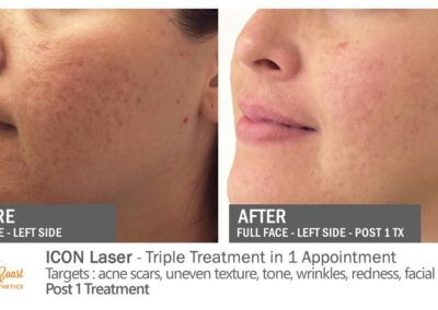 ICON Laser Before and After Photos Irvine CA