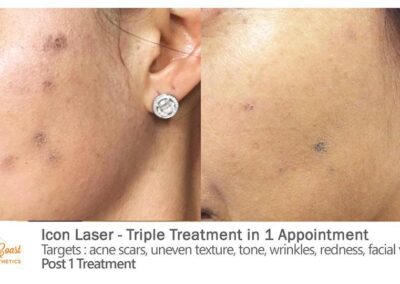 ICON Laser Before and After Photos Irvine CA