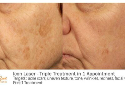 ICON Laser Before and After Photos Irvine CA