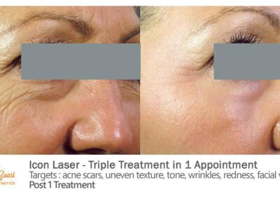 ICON Laser Before and After Photos Irvine CA