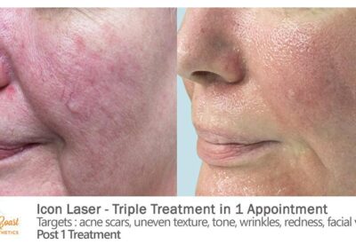 ICON Laser Before and After Photos Irvine CA