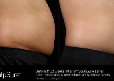 SculpSure Before and After Photos Irvine CA