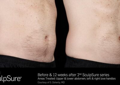 SculpSure Before and After Photos Irvine CA