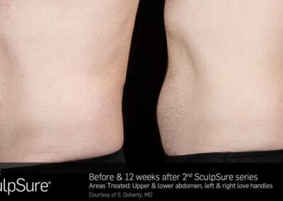 SculpSure Before and After Photos Irvine CA