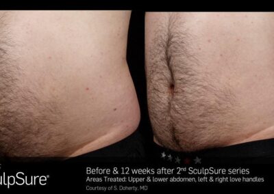 SculpSure Before and After Photos Irvine CA