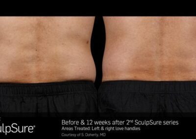 SculpSure Before and After Photos Irvine CA