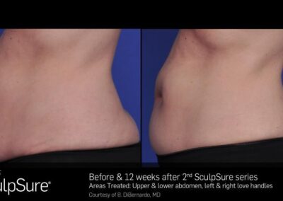 SculpSure Before and After Photos Irvine CA