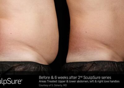 SculpSure Before and After Photos Irvine CA