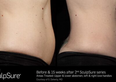 SculpSure Before and After Photos Irvine CA