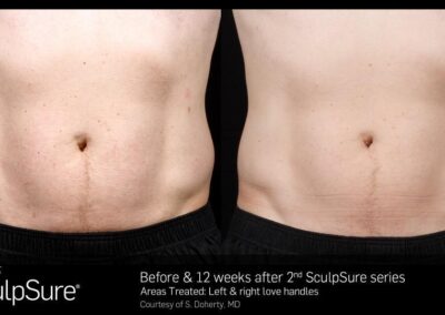 SculpSure Before and After Photos Irvine CA