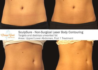 SculpSure Before and After Photos Irvine CA