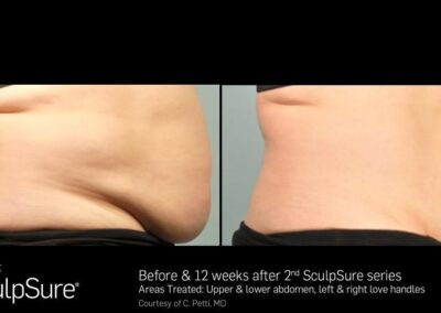 SculpSure Before and After Photos Irvine CA