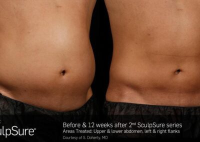 SculpSure Before and After Photos Irvine CA