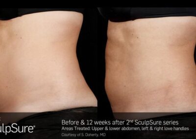 SculpSure Before and After Photos Irvine CA