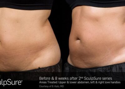 SculpSure Before and After Photos Irvine CA