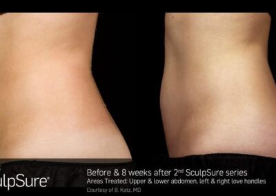 SculpSure Before and After Photos Irvine CA