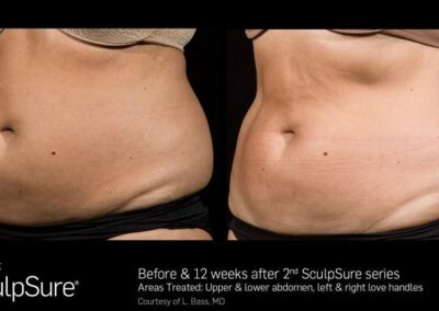 SculpSure Before and After Photos Irvine CA