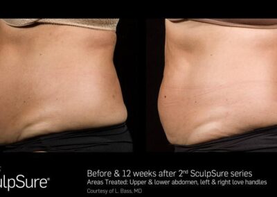 SculpSure Before and After Photos Irvine CA