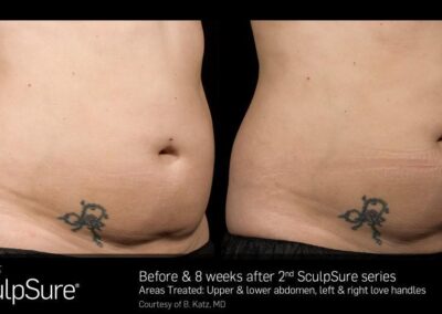 SculpSure Before and After Photos Irvine CA