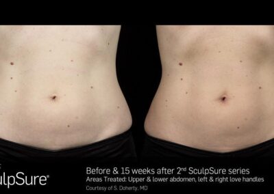 SculpSure Before and After Photos Irvine CA