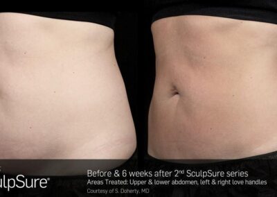 SculpSure Before and After Photos Irvine CA