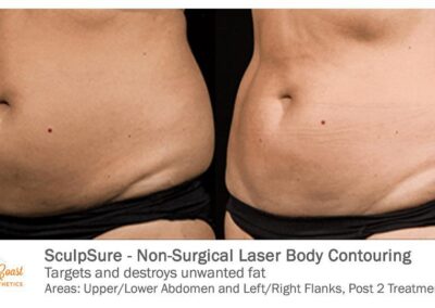 SculpSure Before and After Photos Irvine CA