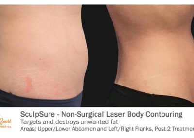 SculpSure Before and After Photos Irvine CA