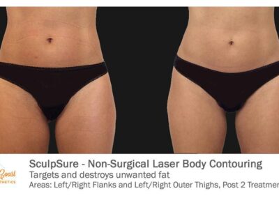 SculpSure Before and After Photos Irvine CA