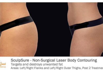 SculpSure Before and After Photos Irvine CA