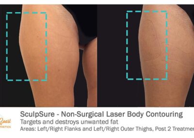 SculpSure Before and After Photos Irvine CA