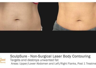 SculpSure Before and After Photos Irvine CA