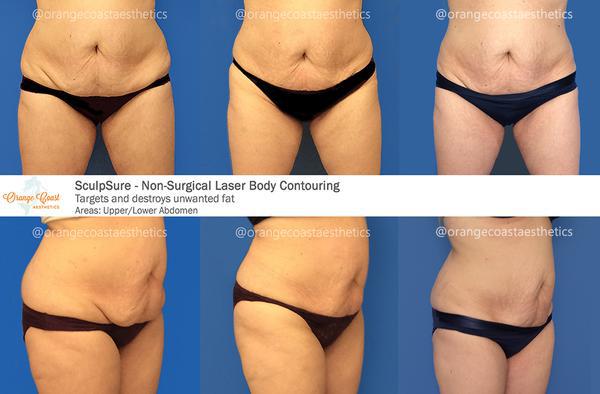 Body Contouring