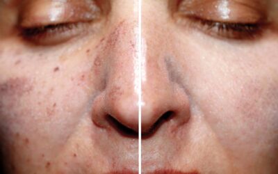 See Dark Spots Go with PicoSure Laser Skin Rejuvenation