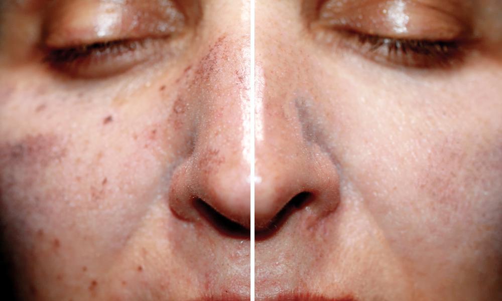 PicoSure Laser Skin Rejuvenation