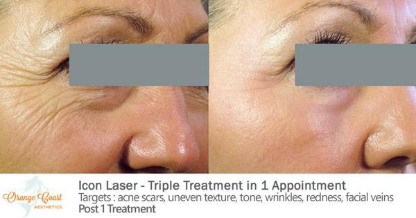 Laser Skin Resurfacing