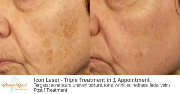 Laser Skin Resurfacing