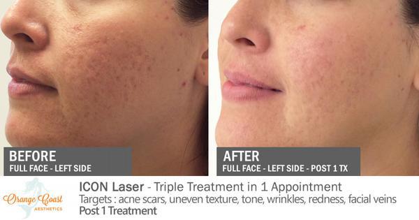 Laser Skin Resurfacing