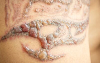 Does Laser Tattoo Removal leave Scars or Blisters?