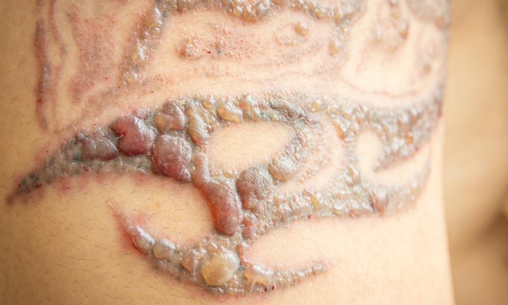 Overskrift Fortælle Busk Does Laser Tattoo Removal leave Scars or Blisters? - Orange Coast Aesthetics