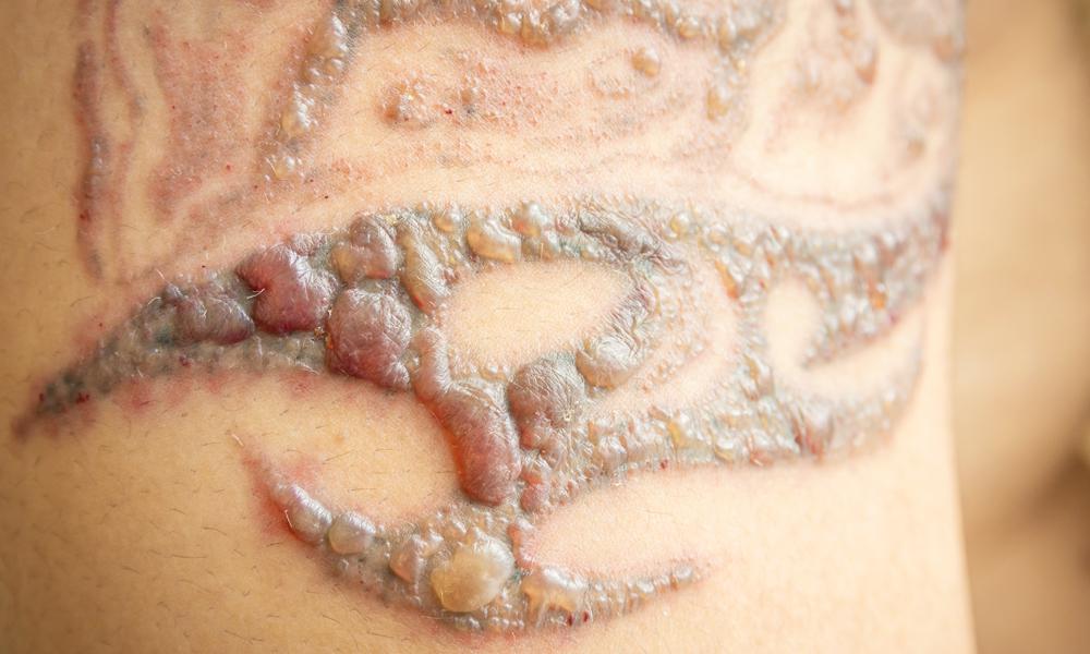 Does Laser Tattoo Removal leave Scars or Blisters? - Orange Coast Aesthetics