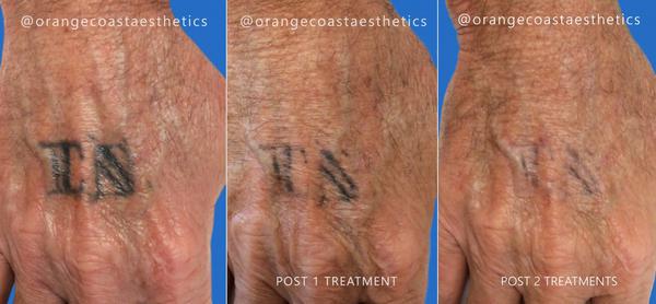 Does Laser Tattoo Removal leave Scars