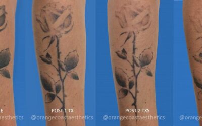Frequently Asked Questions about Laser Tattoo Removal