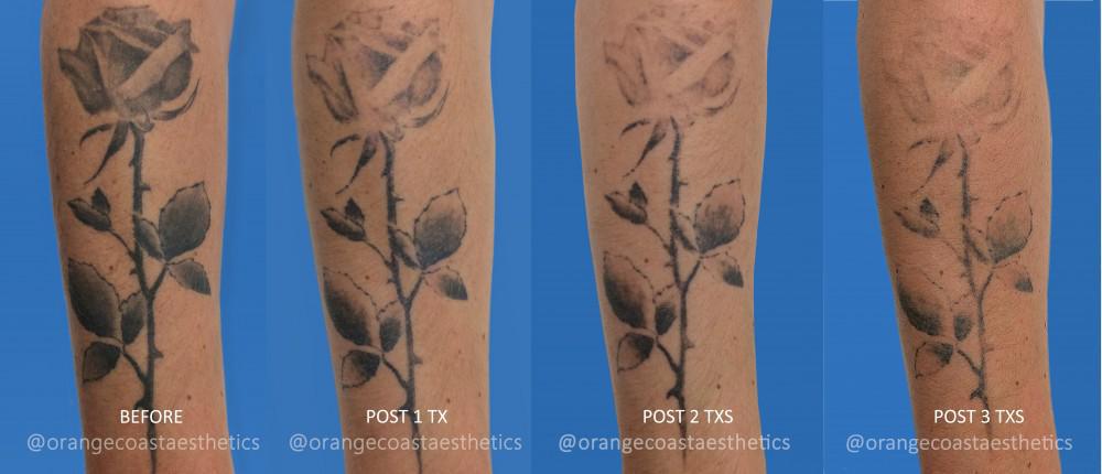 Achromic laser tattoo scars a Baseline achromic scars in left deltoid   Download Scientific Diagram