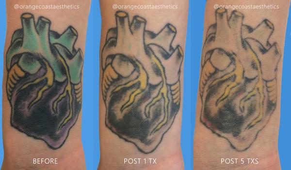 Overskrift Fortælle Busk Does Laser Tattoo Removal leave Scars or Blisters? - Orange Coast Aesthetics