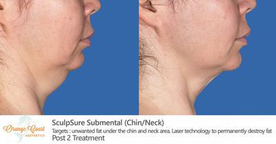 Chin and Neck Reduction