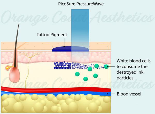 Pico PressureWave